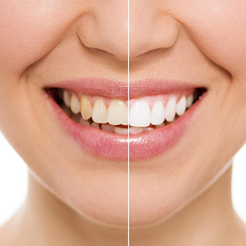 Teeth Whitening in Vijayawada